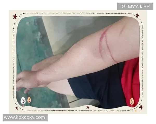 打篮球时腿部拉伤后应如何选择合适的药物进行治疗和缓解疼痛 打篮球时腿部拉伤后应如何选择合适的药物进行治疗和缓解疼痛